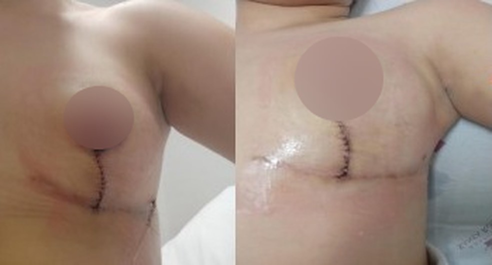 O seio da paciente ficou deformado após uma cirurgia para a retirada da prótese de silicone — Foto: Reprodução