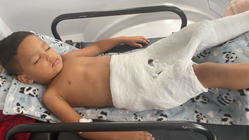 Bryan Vinicius recebeu alta hospitalar após cair e quebrar o fêmur em Votuporanga (SP) — Foto: Cinthia Magalhães/Arquivo pessoal