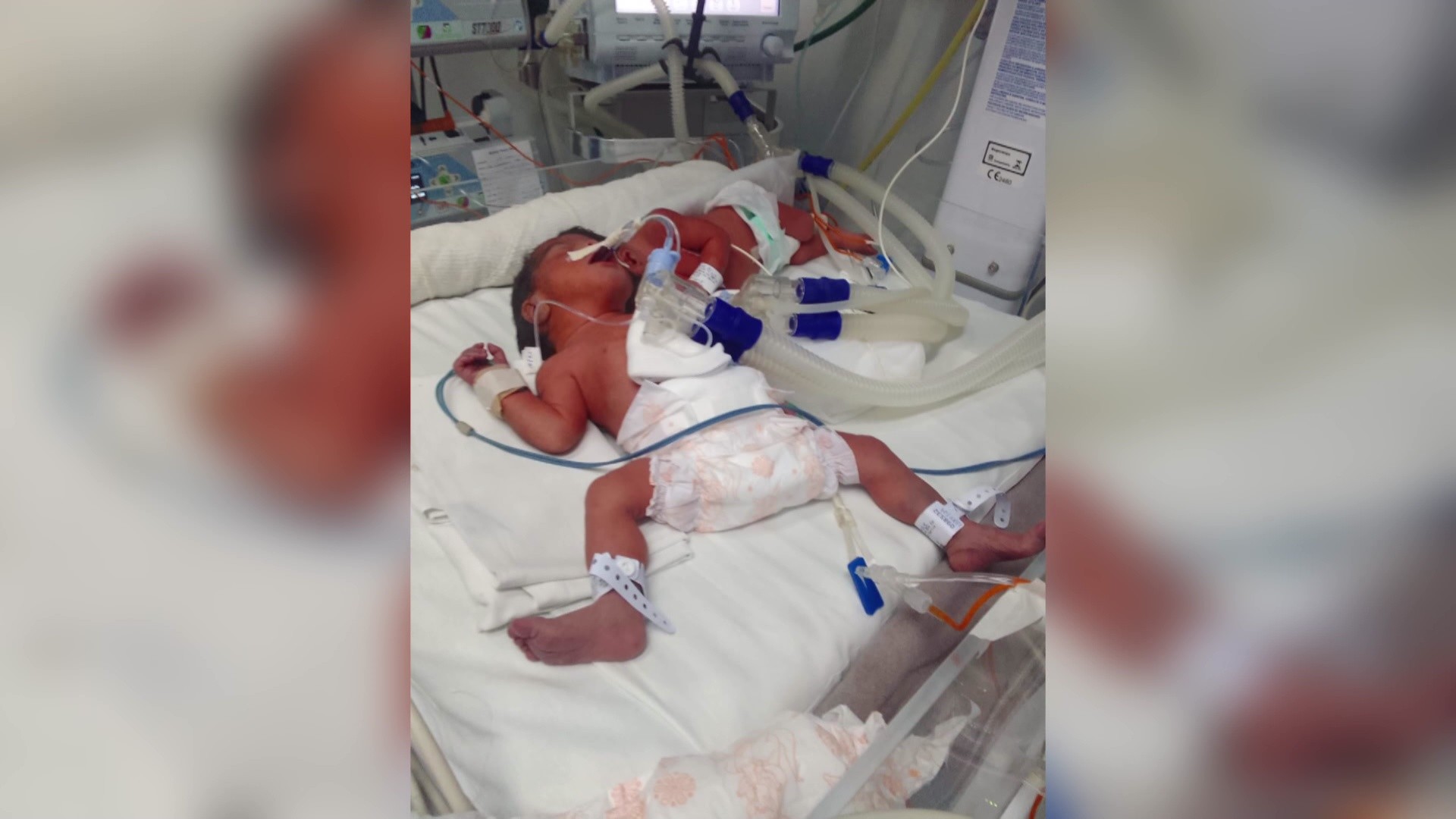 Entenda o que falta e o tempo estimado para gêmeas unidas pela cabeça serem totalmente separadas em Ribeirão Preto