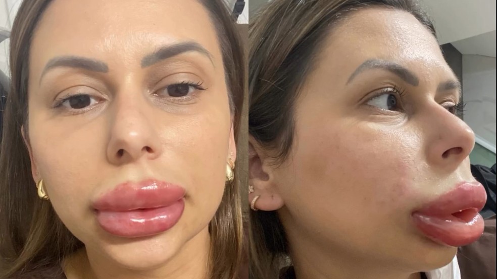 Woman's Cosmetic Procedure Goes Viral After Unexpected Result, Experts Explain What May Have Gone Wrong