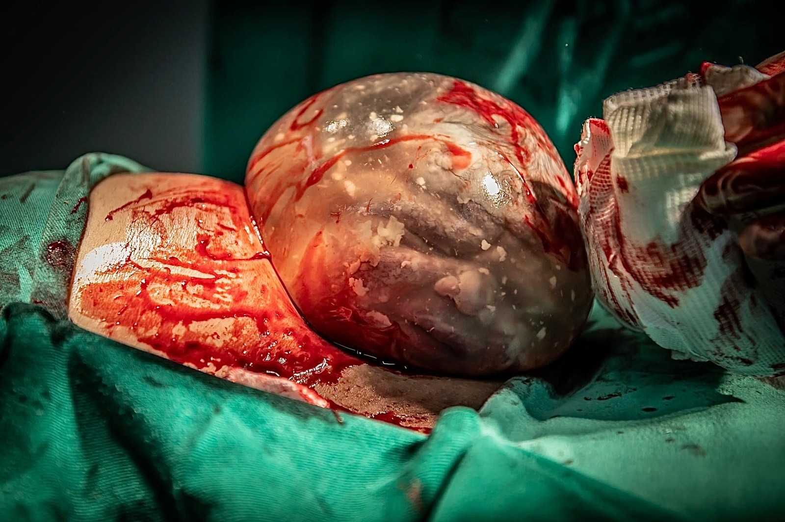 Fotgrafa registra quatro raros partos de bebs empelicados em menos de 2 anos: ?Me sinto muito privilegiada'
