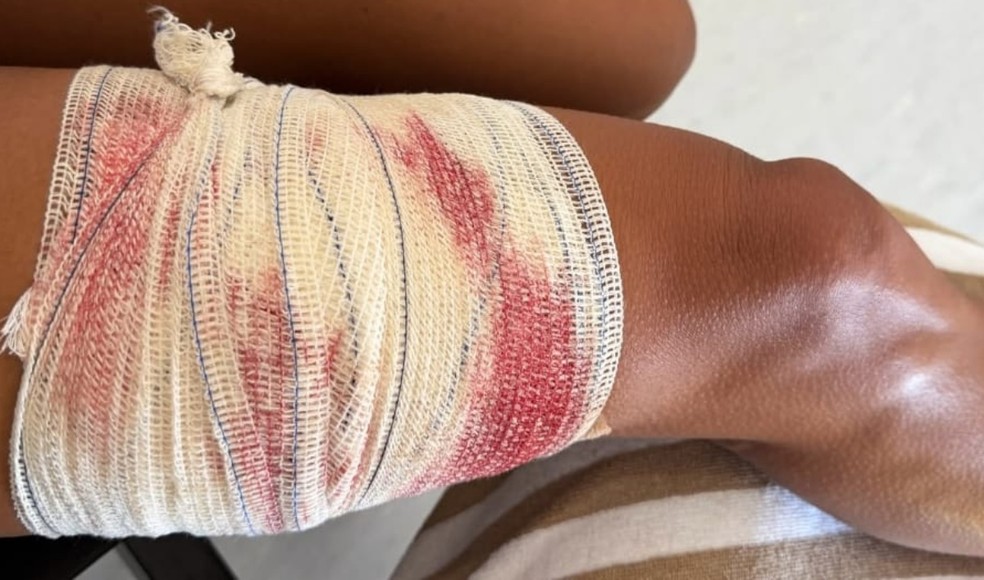 Turista foi mordida na perna — Foto: Instagram