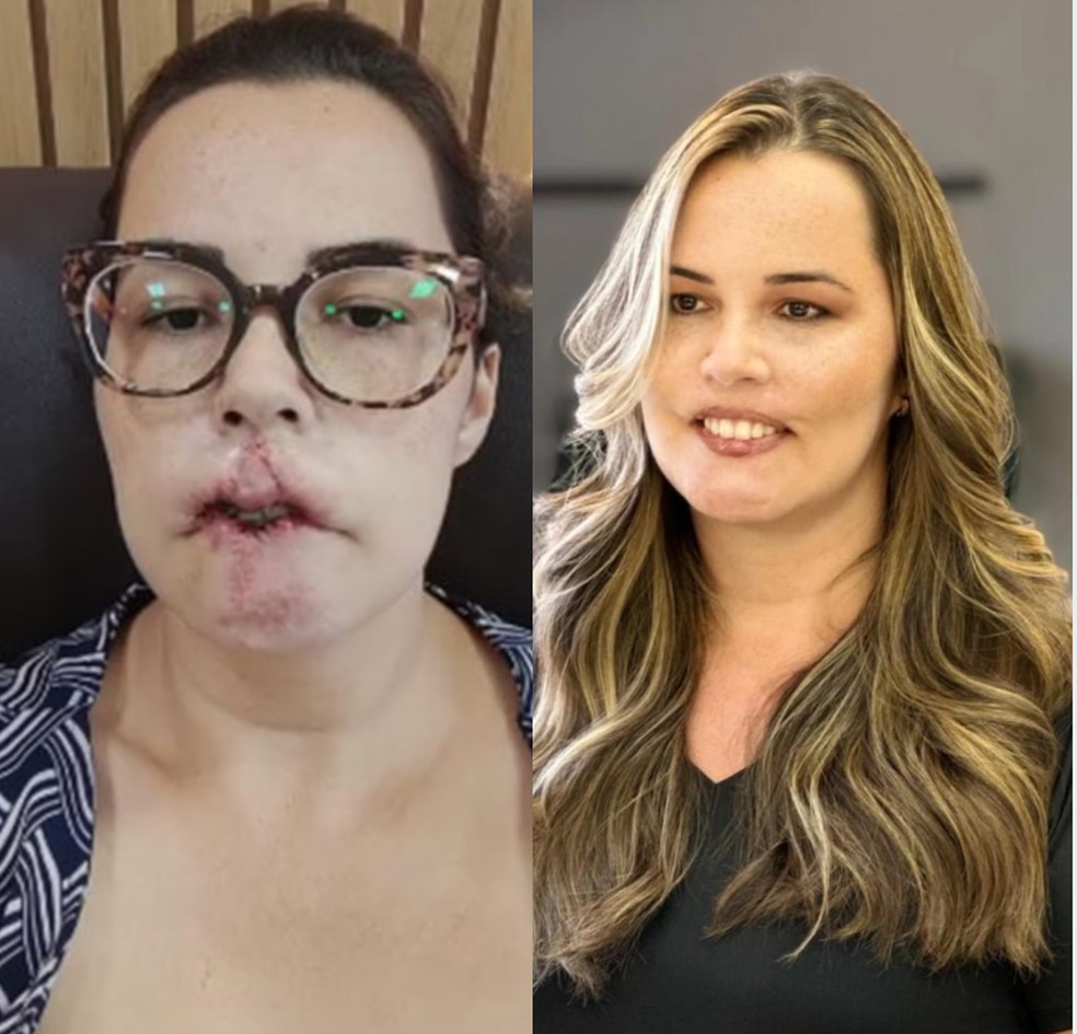 À esquerda, Mariana Michelini após a primeira cirurgia de reconstrução do lábio; à direita, após a conclusão dos três enxertos  — Foto: Arquivo pessoal