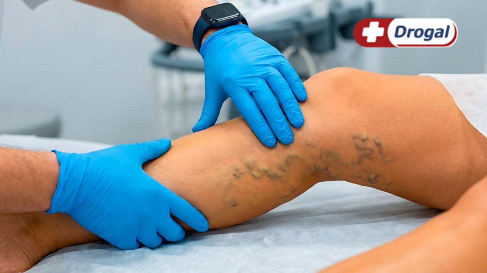 Insuficiência venosa: veja sintomas e tratamentos disponíveis