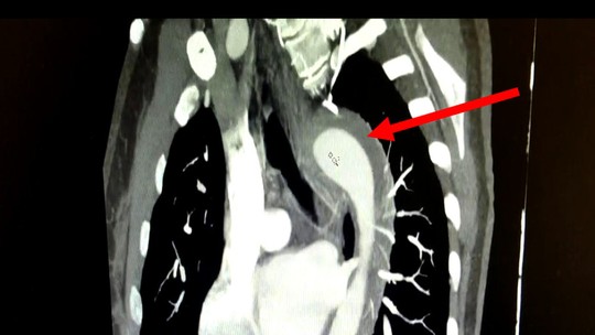 Em caso raro, mulher de 45 anos rompe aorta após orgasmo; entenda a condição - Paciente chegou à emergência com queixas de dores toráxicas. Segundo os médicos que atenderam o caso, o histórico médico incluía hipertensão, não tratada há um ano, e tabagismo há 17 anos.