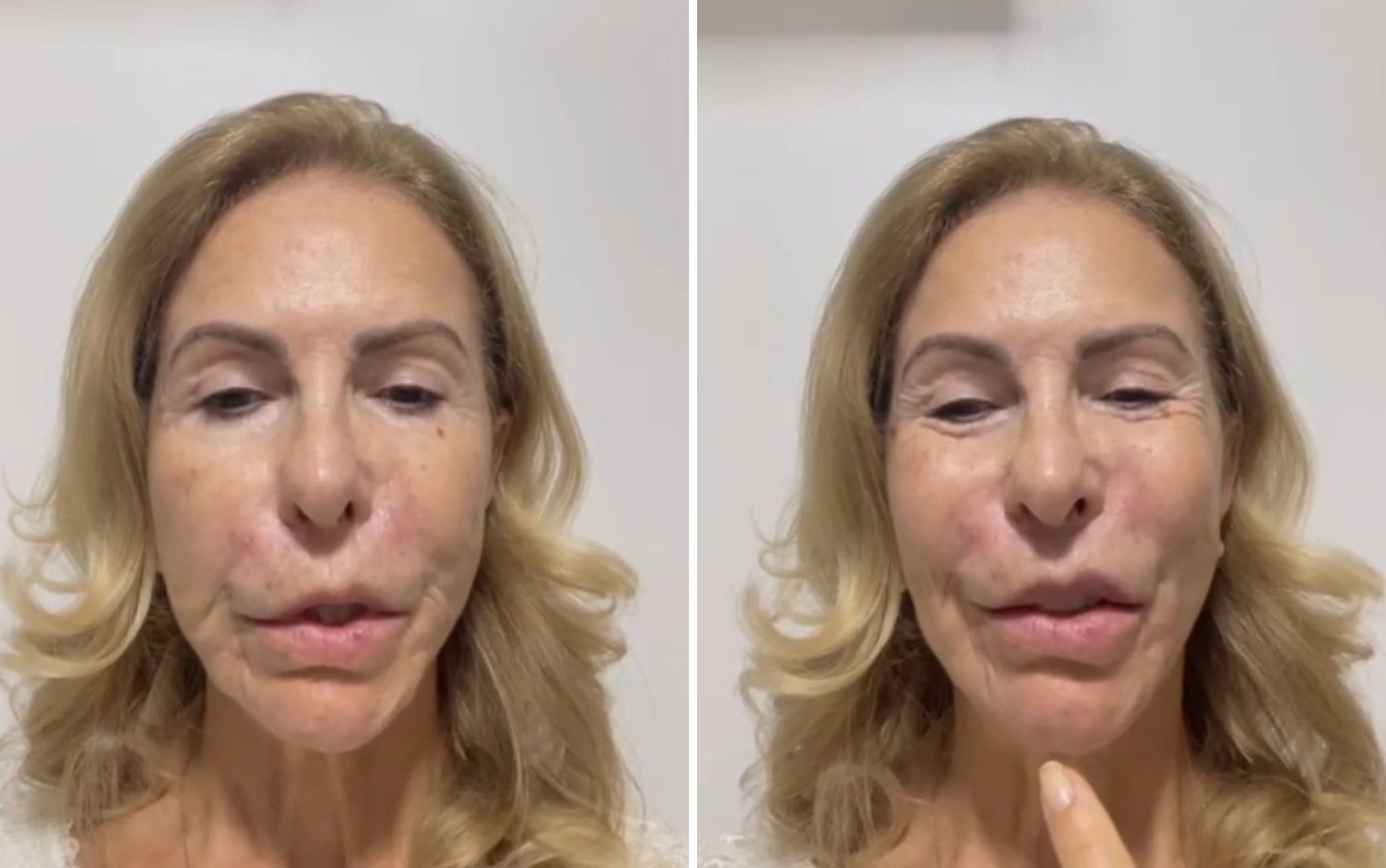 Psicóloga denuncia dentista por sequelas após procedimento estético: 'Meu lábio superior não movimenta'