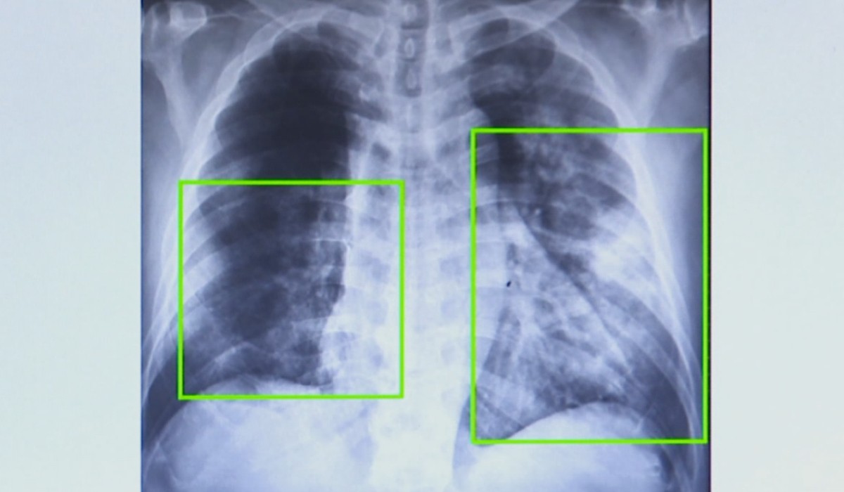 Atendimentos por pneumonia quase dobram em 7 meses na região de Campinas; veja sintomas e como  prevenir