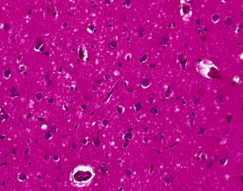 Imagem microscópica mostra alterações no tecido cerebral associadas à doença de Creutzfeldt-Jakob, com aspecto esponjoso causado pela formação de pequenas cavidades. — Foto: DRdoubleB/Wikimedia Commons