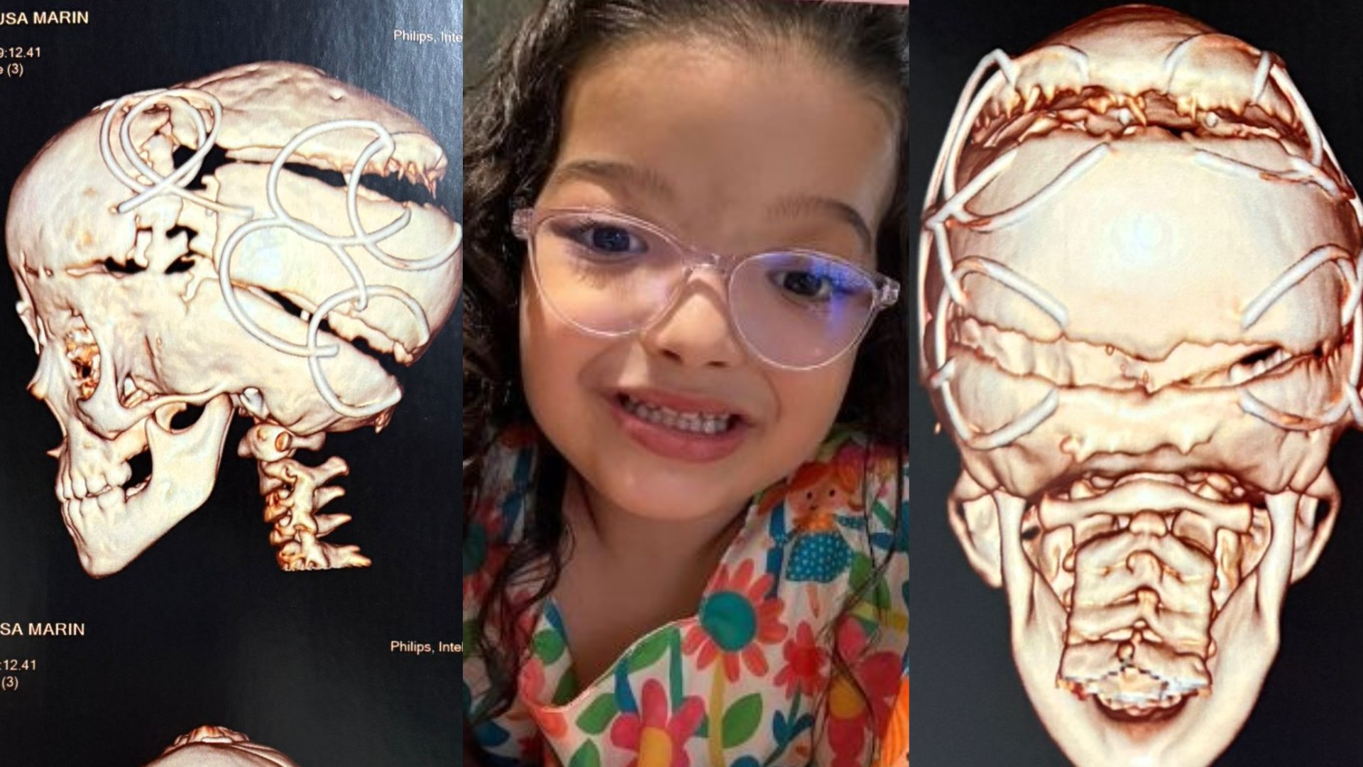 Criança com doença rara no crânio passa por 4ª cirurgia para evitar danos ao cérebro em MT