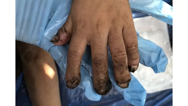 MPF investiga DSEI Yanomami por irregularidades em tratamento para 'bicho-de-pé'