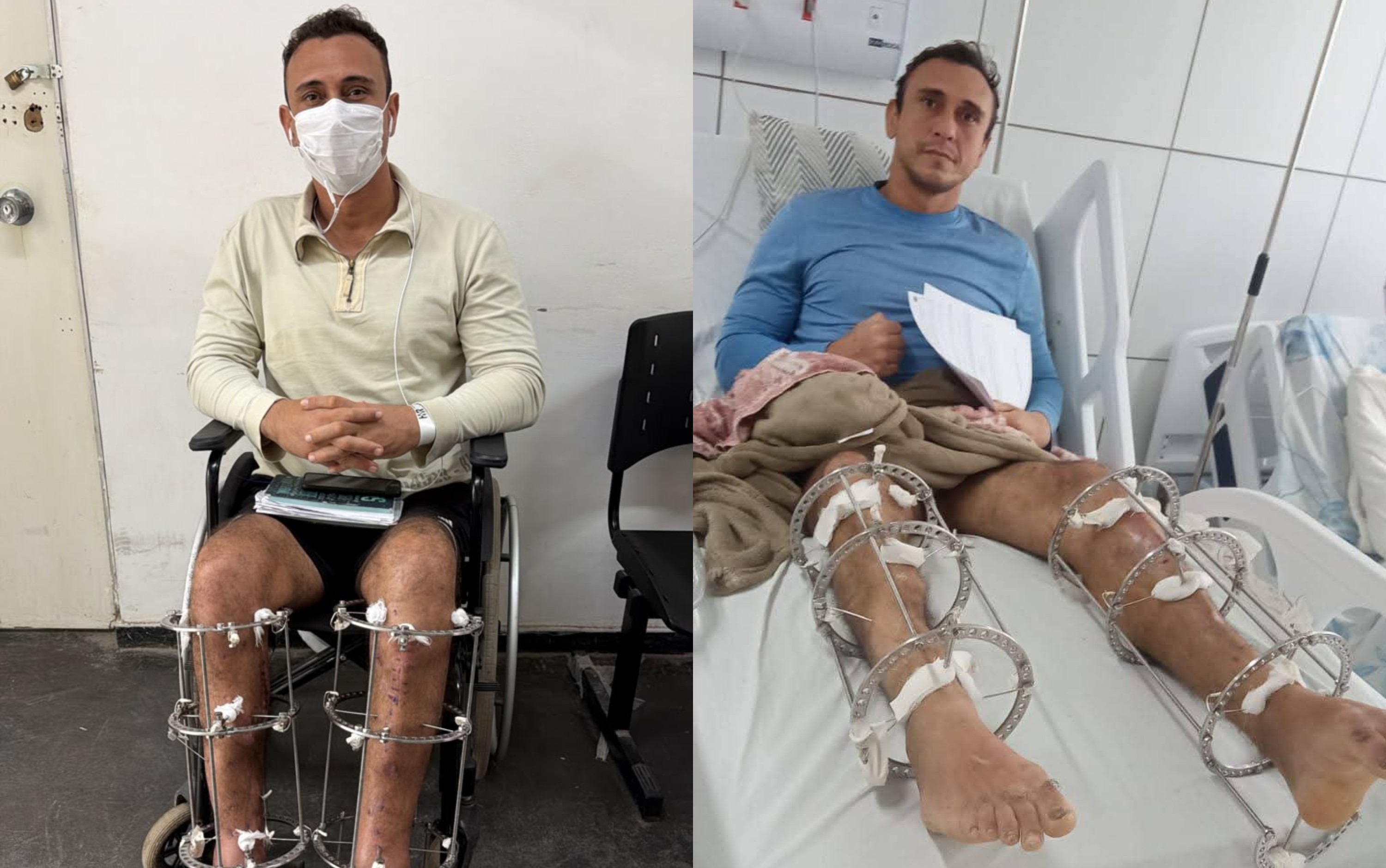 Пациент в бразильском госпитале обнаружил личинок мух в открытой ране после ДТП