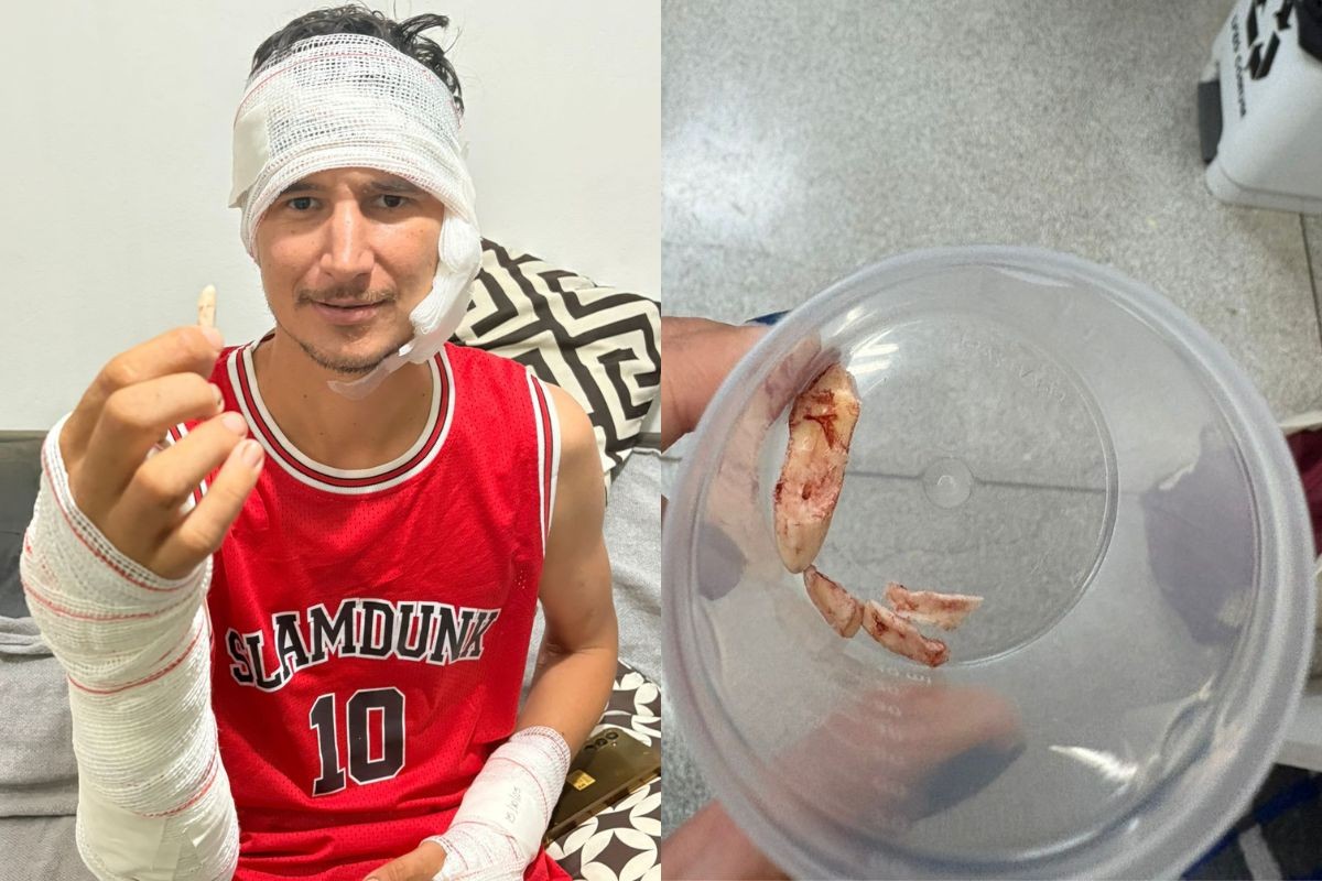 Peão guarda como amuleto garra de onça que ficou cravada em perna durante ataque no Pantanal