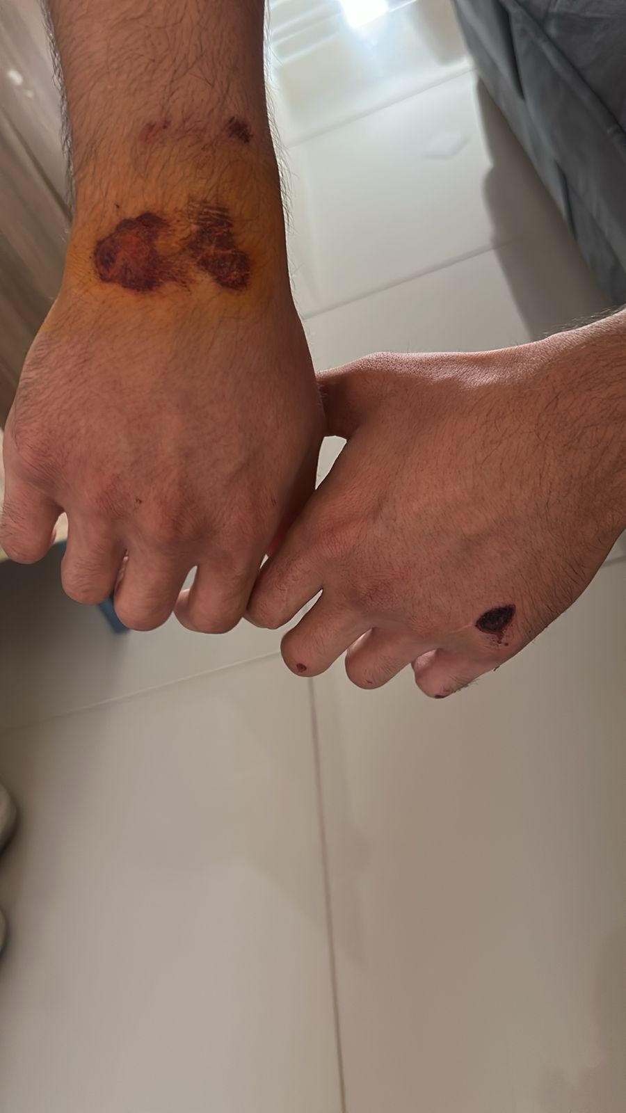 ‘Eu fui capotando, senti impotência mesmo, não dava para fazer nada’, desabafa motociclista que caiu em buraco em Mogi das Cruzes 