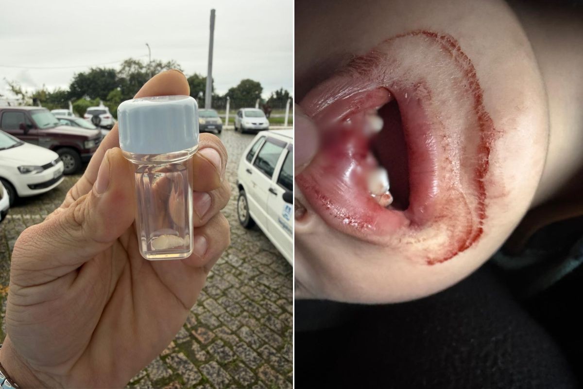 Menino de 2 anos tem dente quebrado após queda em creche do interior de SP