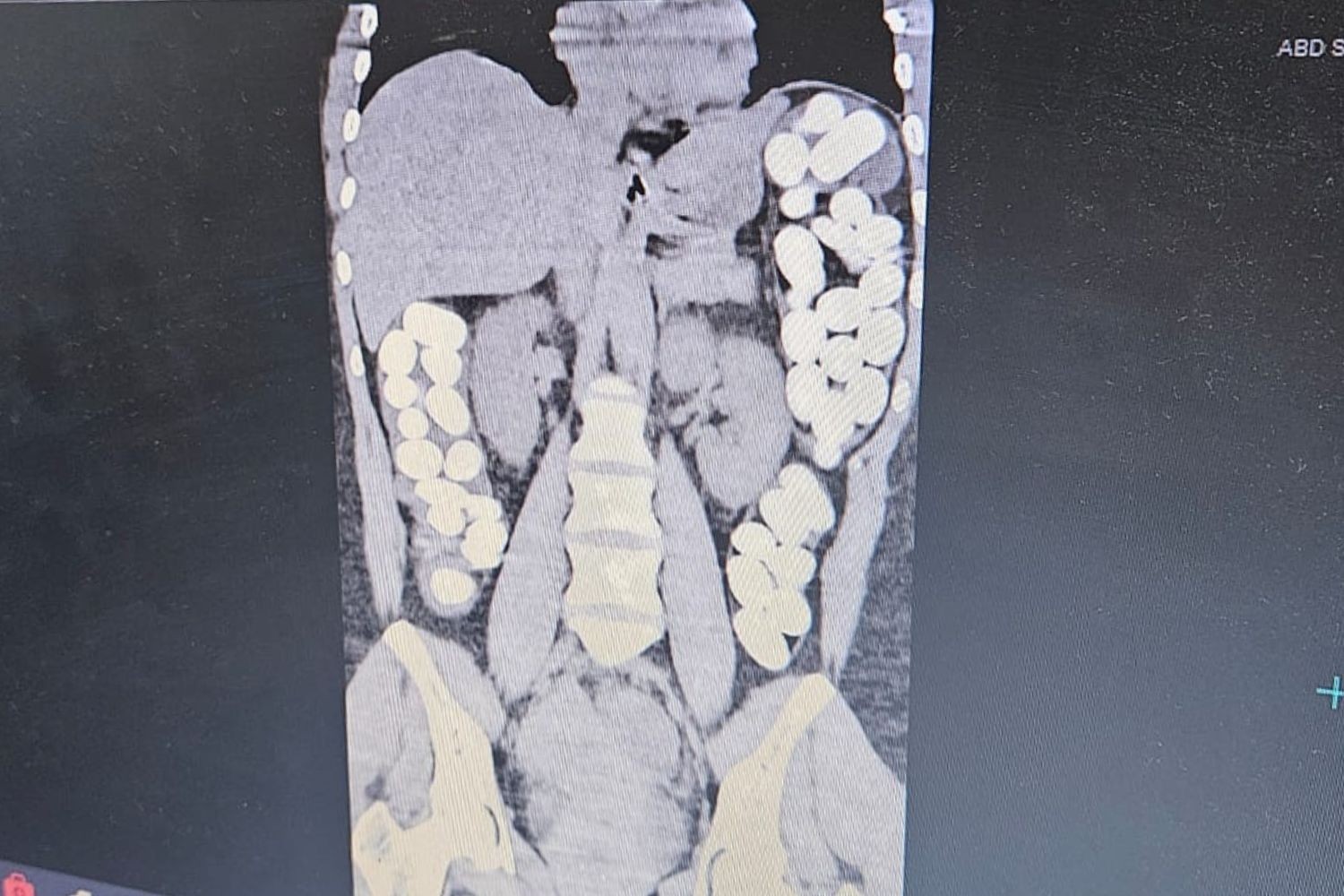 Mulher dá entrada em pronto-socorro com crise convulsiva, e exame encontra cápsulas com drogas no intestino