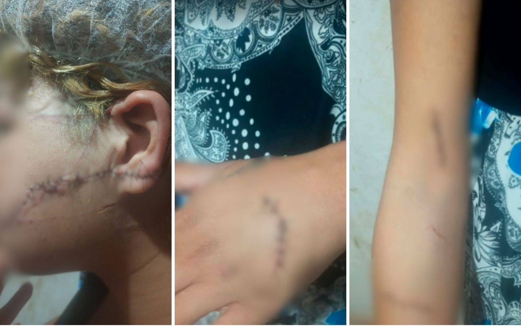 Ex-marido é preso suspeito de cortar o rosto e orelha de mulher; imagem forte