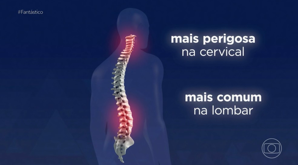 Hérnia de disco foi a doença que mais gerou afastamento do trabalho em 2023 — Foto: Reprodução/Fantástico