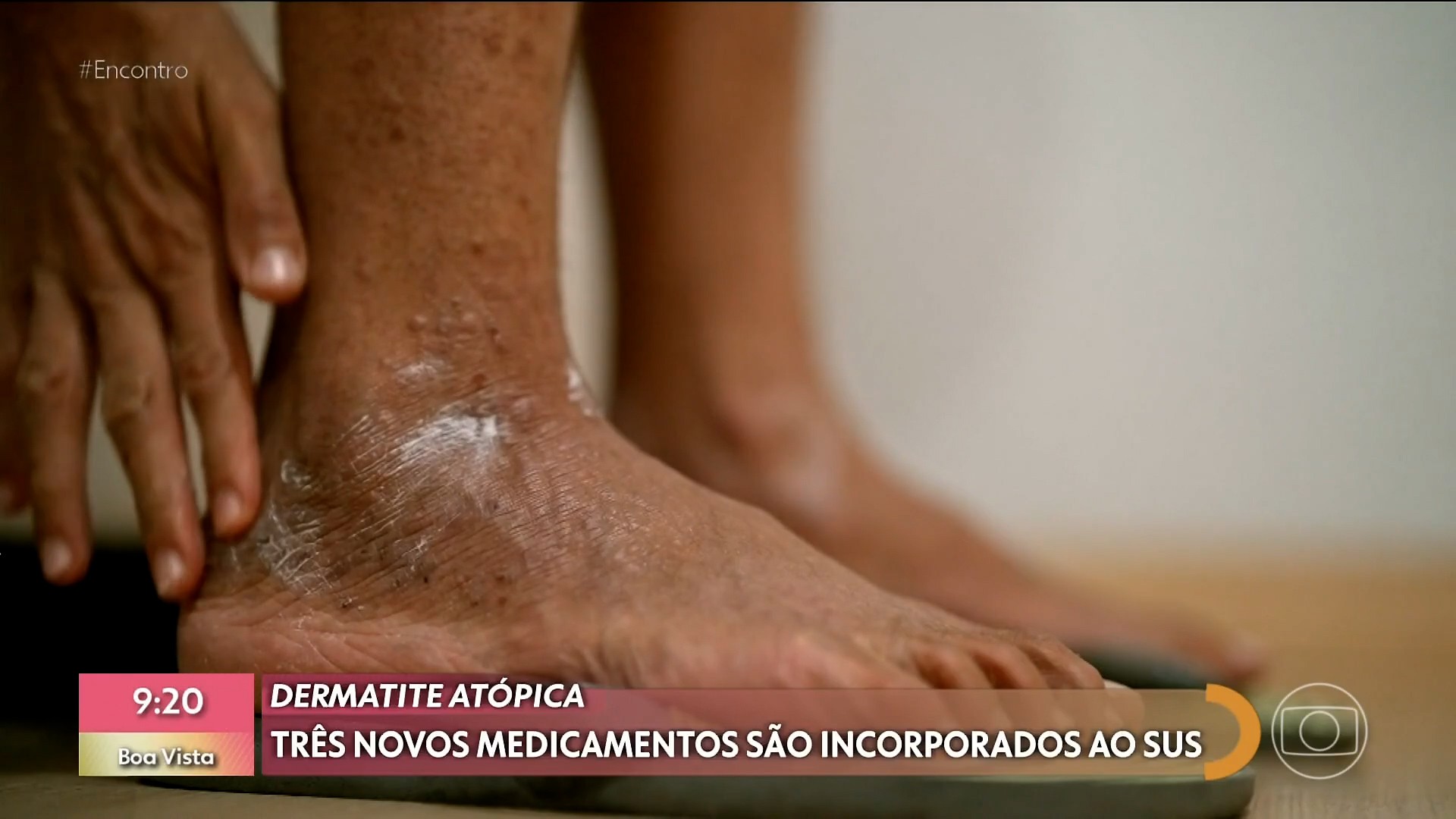 Coceira, inflamação e machucados: SUS passa a oferecer novos remédios contra dermatite atópica