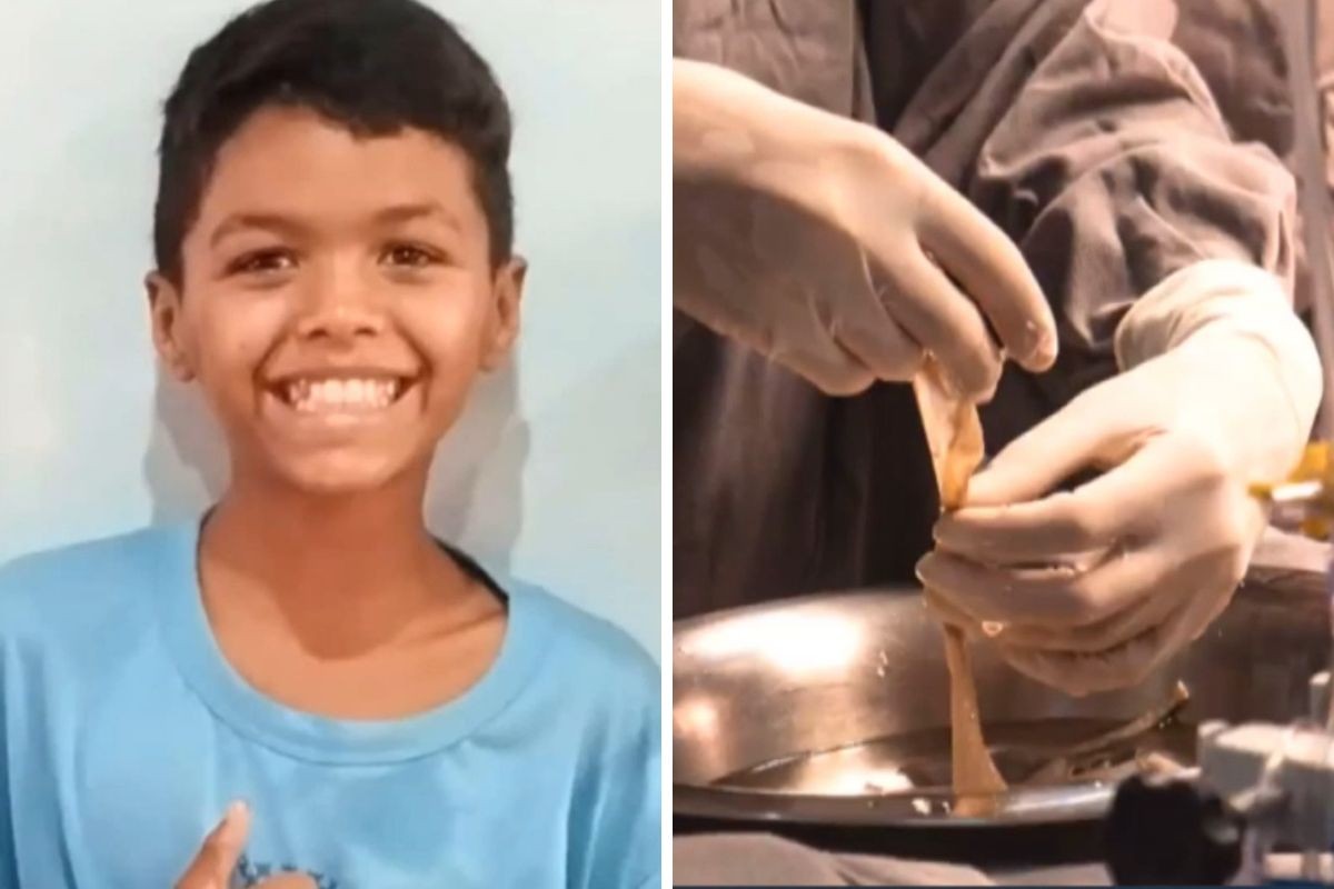 Menino de 11 anos com 60% do corpo queimado recebe pele de doadores em tratamento inédito em MS