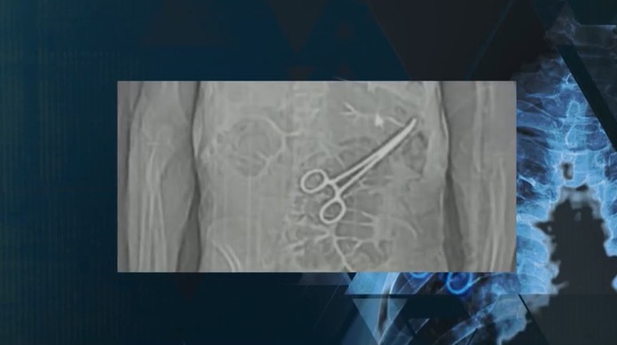 Pinça gigante, compressa cirúrgica, gaze: veja casos de objetos esquecidos dentro do corpo de pacientes no Brasil 