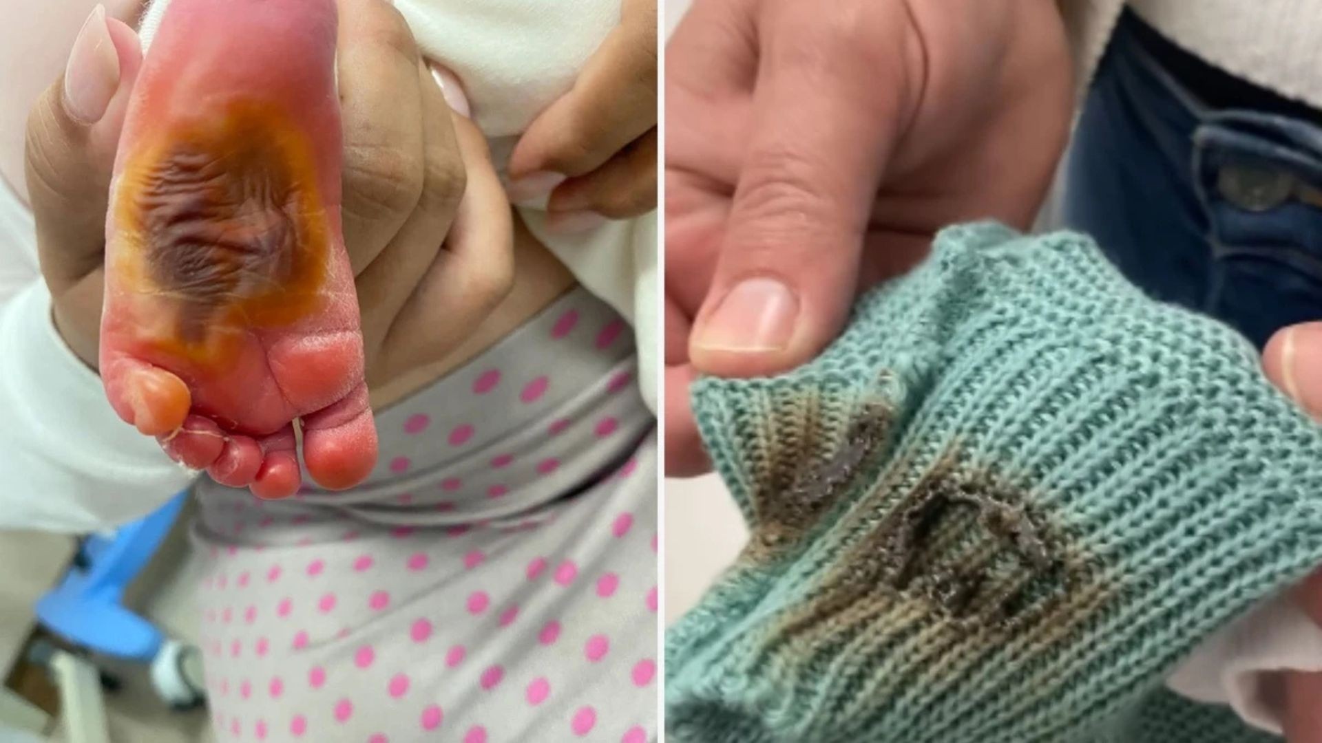 'Orando para sair desse inferno', diz avó de bebê de 1 dia de vida que teve o pé queimado com algodão em hospital