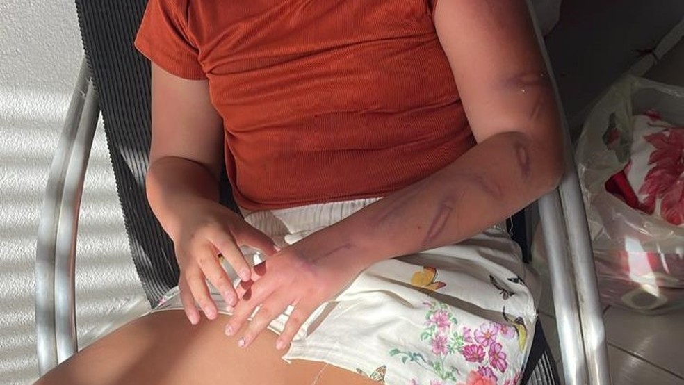 Menina de 11 anos apresentava hematomas nos braços e pernas após apanhar da mãe — Foto: Reprodução/WhatsApp