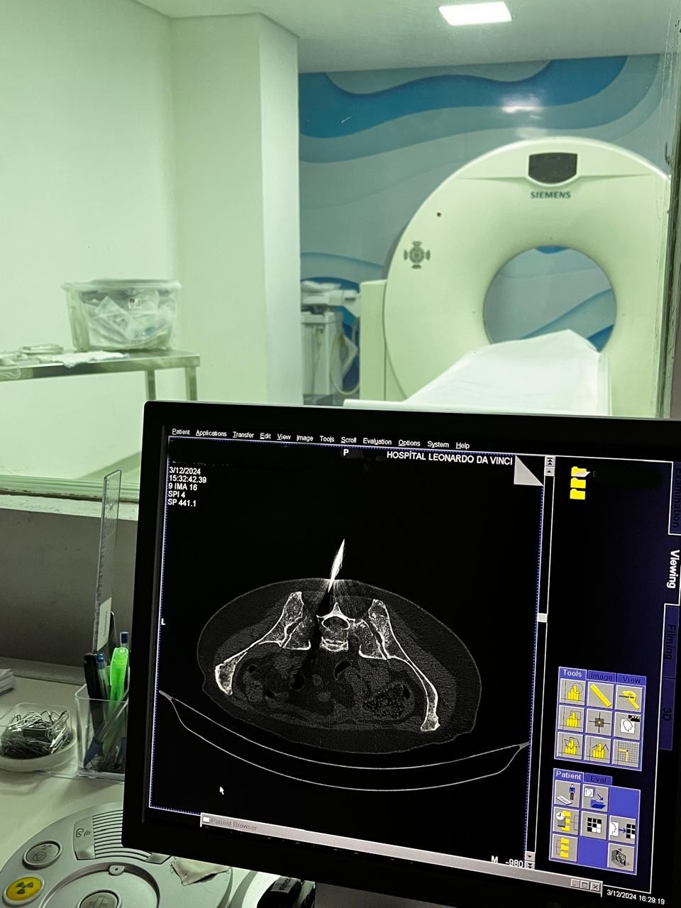 Hospital Leonardo da Vinci realiza primeira biópsia com equipamento moderno