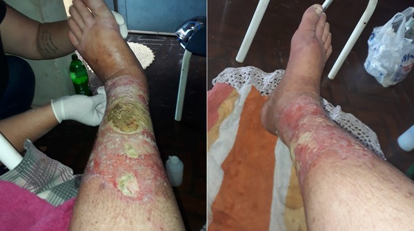Fot&oacute;grafo de Araras ficou com as pernas comprometidas por conta de erisipela bolhosa &mdash; Foto: Reprodu&ccedil;&atilde;o/Facebook