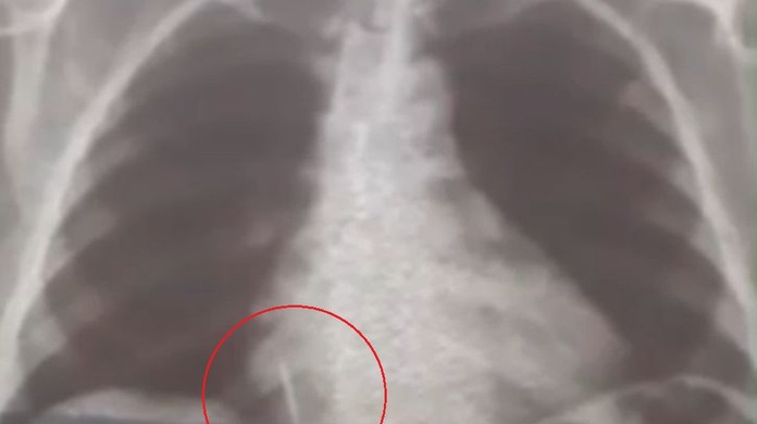 Criança sai de hospital com agulha “esquecida” no braço, na Paraíba
