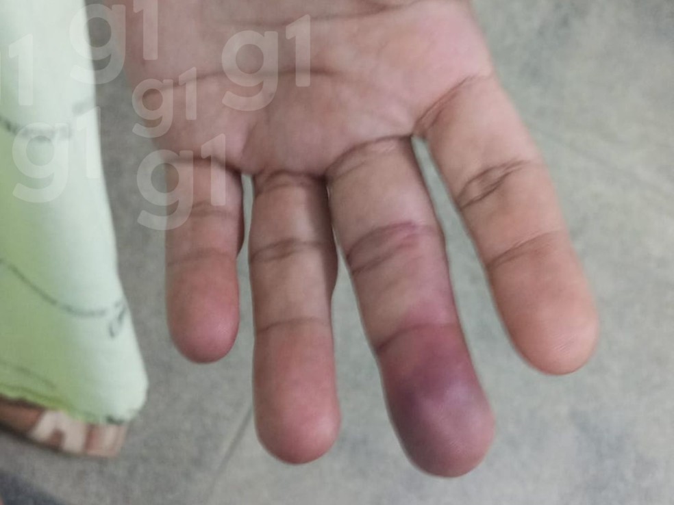 Passageira teve fratura no dedo e precisou passar por cirurgia em Cruzeiro do Sul — Foto: Arquivo pessoal
