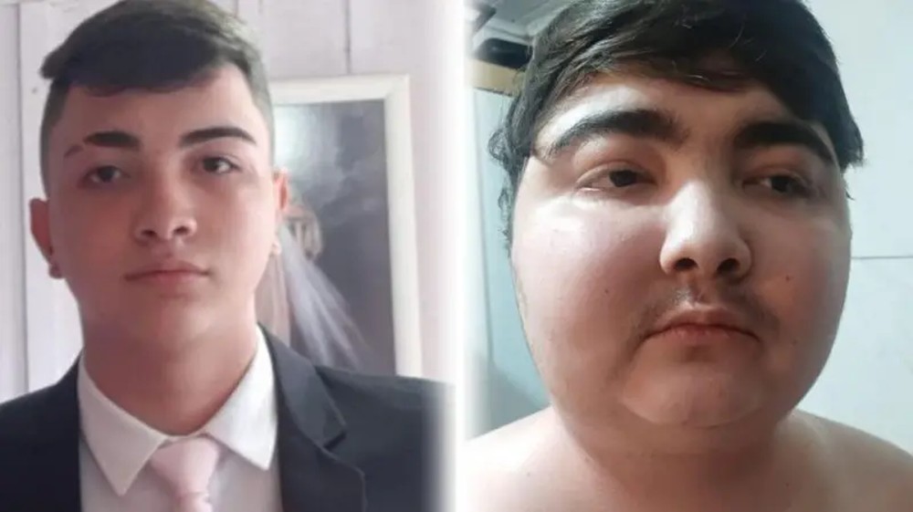 Adolescente de 16 anos trata doença rara após ganhar mais de 40 quilos em um ano