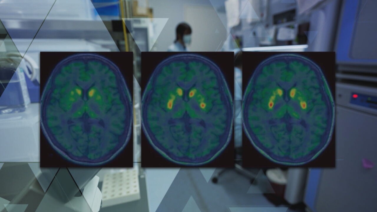 Pesquisa no Japão usa terapia celular e apresenta resultados inéditos no tratamento do Parkinson