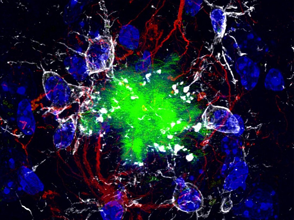Imagem de microscopia mostra placas de proteína beta-amiloide, ligadas ao Alzheimer, em tons fluorescentes no tecido cerebral. — Foto: Wikimedia/Domínio Público