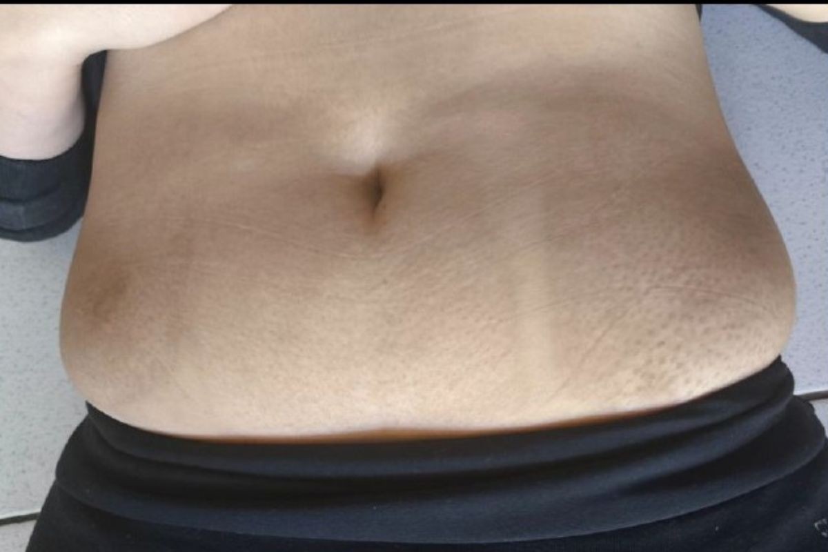 Clinica de estética interditada é processada por cliente que teve queimaduras de 3º grau em criolipólise