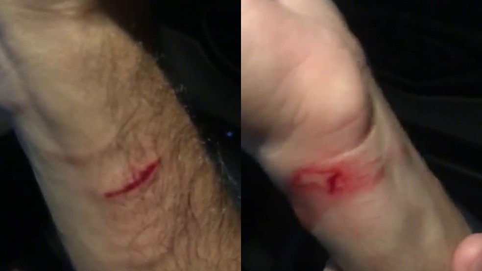 Felipe Dias também disse ter sido atacado por cão solto da coleira no Parque do Cocó. — Foto: Arquivo pessoal