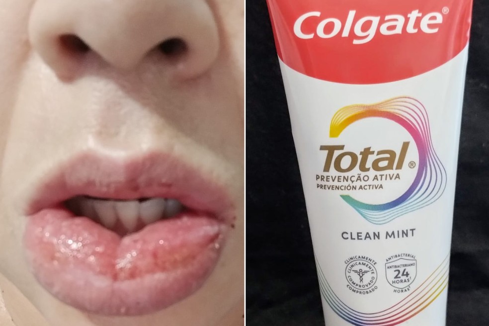 Educadora social, de 45 anos, sofre reação alérgica após uso de pasta de dente, em Miracatu (SP) — Foto: Arquivo Pessoal