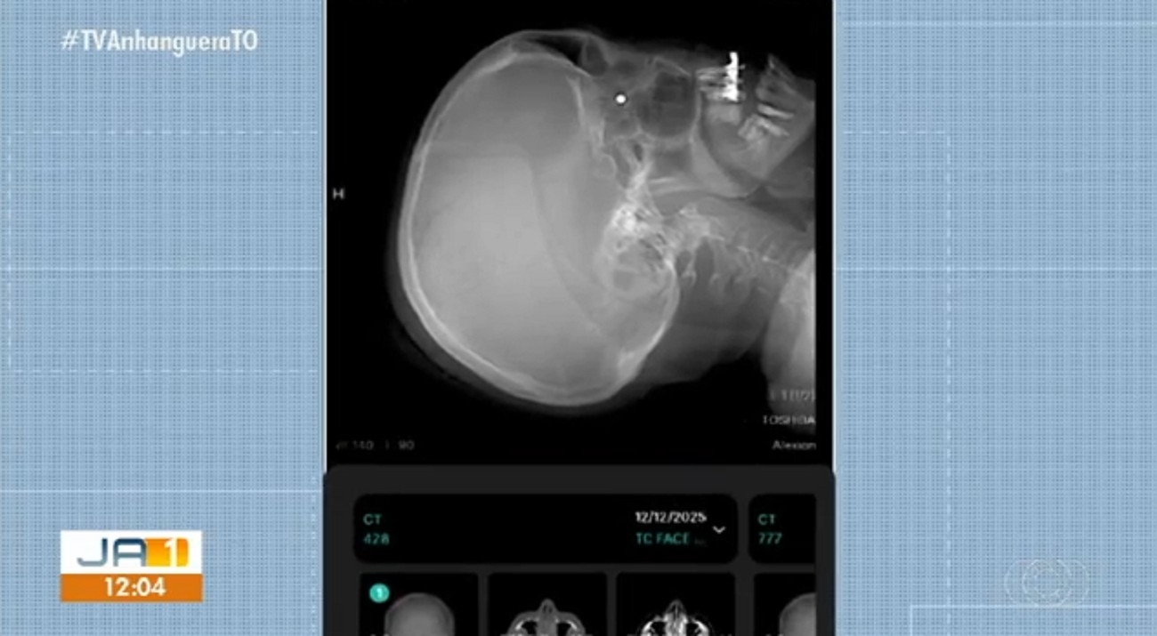 Mulher atingida por tiro em barraca de parque está com chumbinho alojado no olho