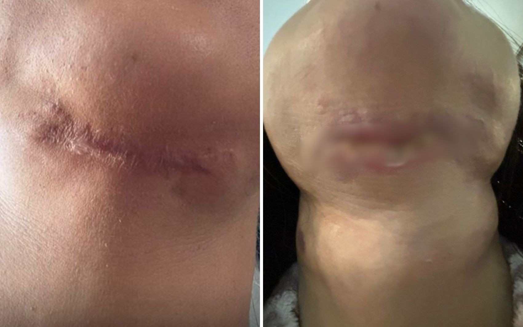 Paciente que denunciou dentista suspeita de deformar clientes diz que ficou um ano sem conseguir mexer a boca e o pescoço: ‘Vontade de morrer’ 