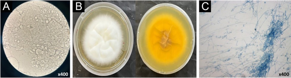 Exames micolgicos de Trichophyton indotineae  Foto: Veasey et al., 2025/Anais Brasileiros de Dermatologia