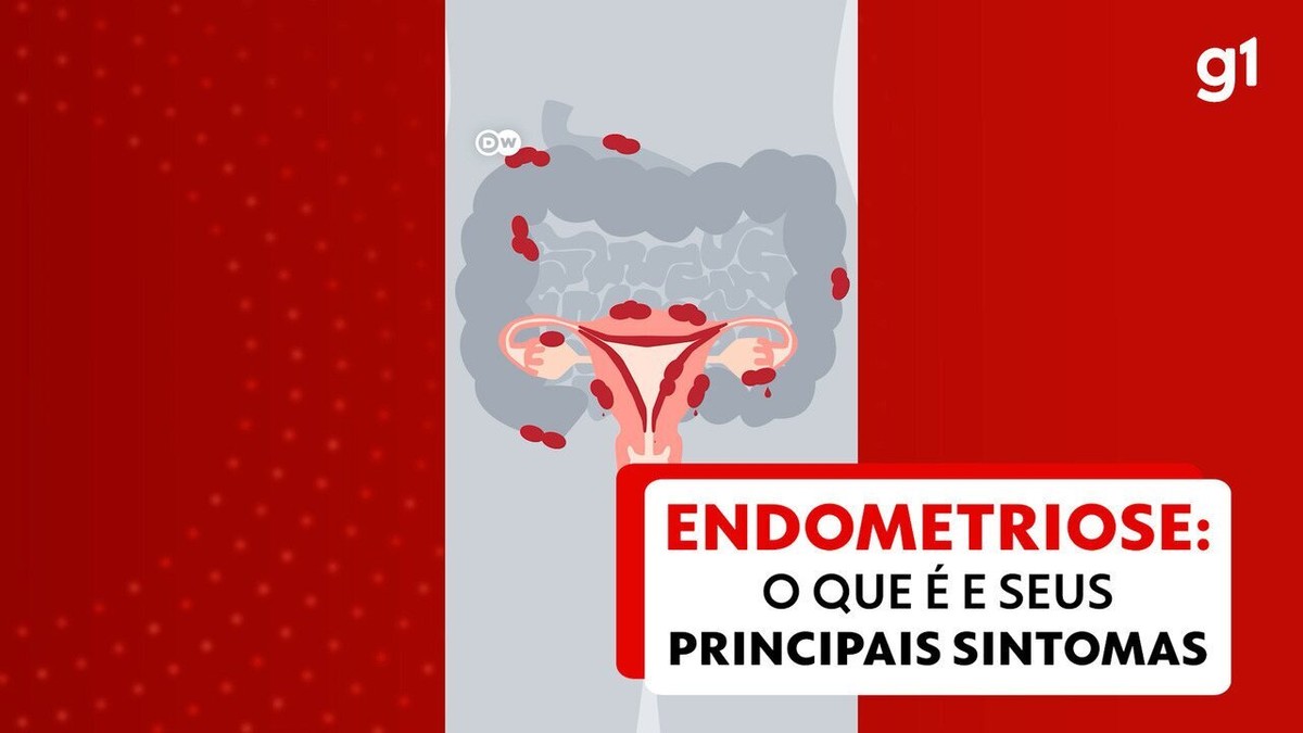 Endometriose: o que é e quais os seus principais sintomas?