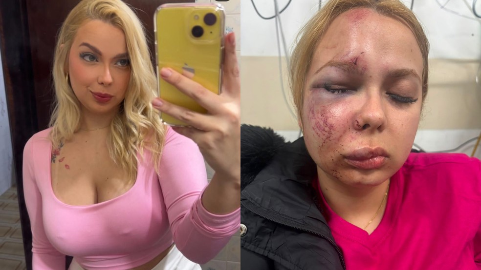 larissa-vitima-do-metro-1- Agressão no Metrô de SP: Jovem sofre fraturas graves e agressor é liberado; pai critica segurança