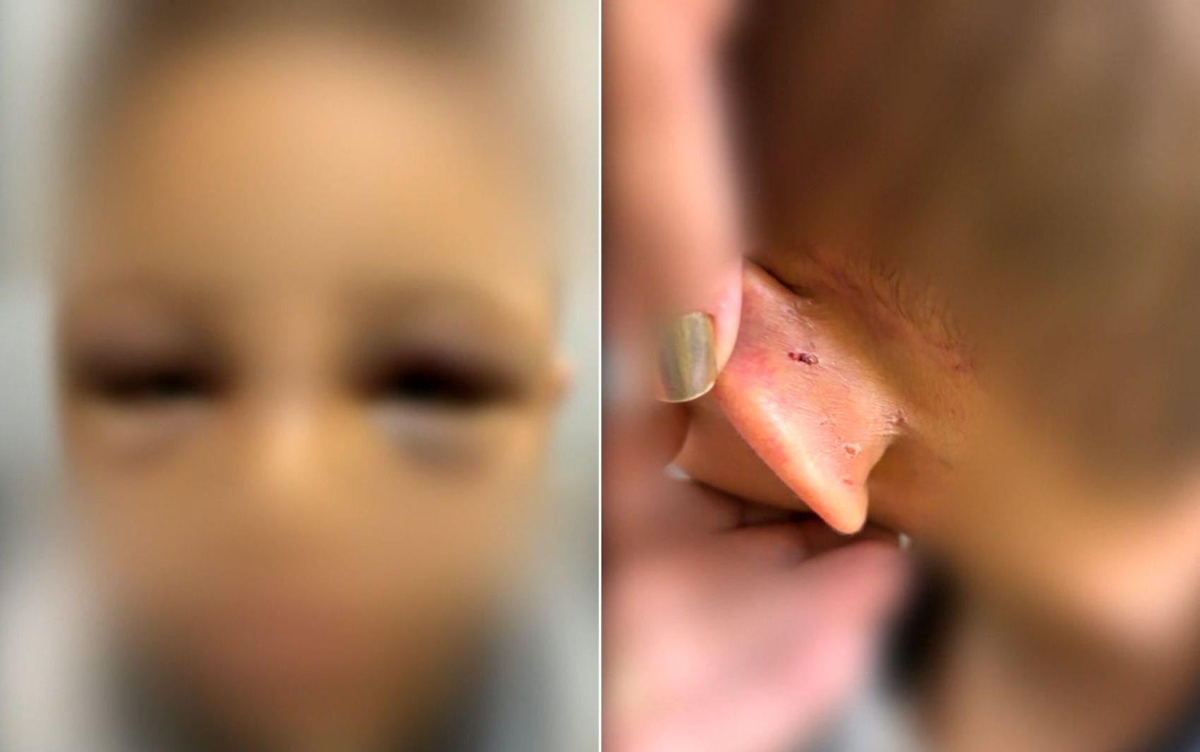 Pai é preso suspeito de espancar o filho de 6 anos após criança ser internada com vários hematomas