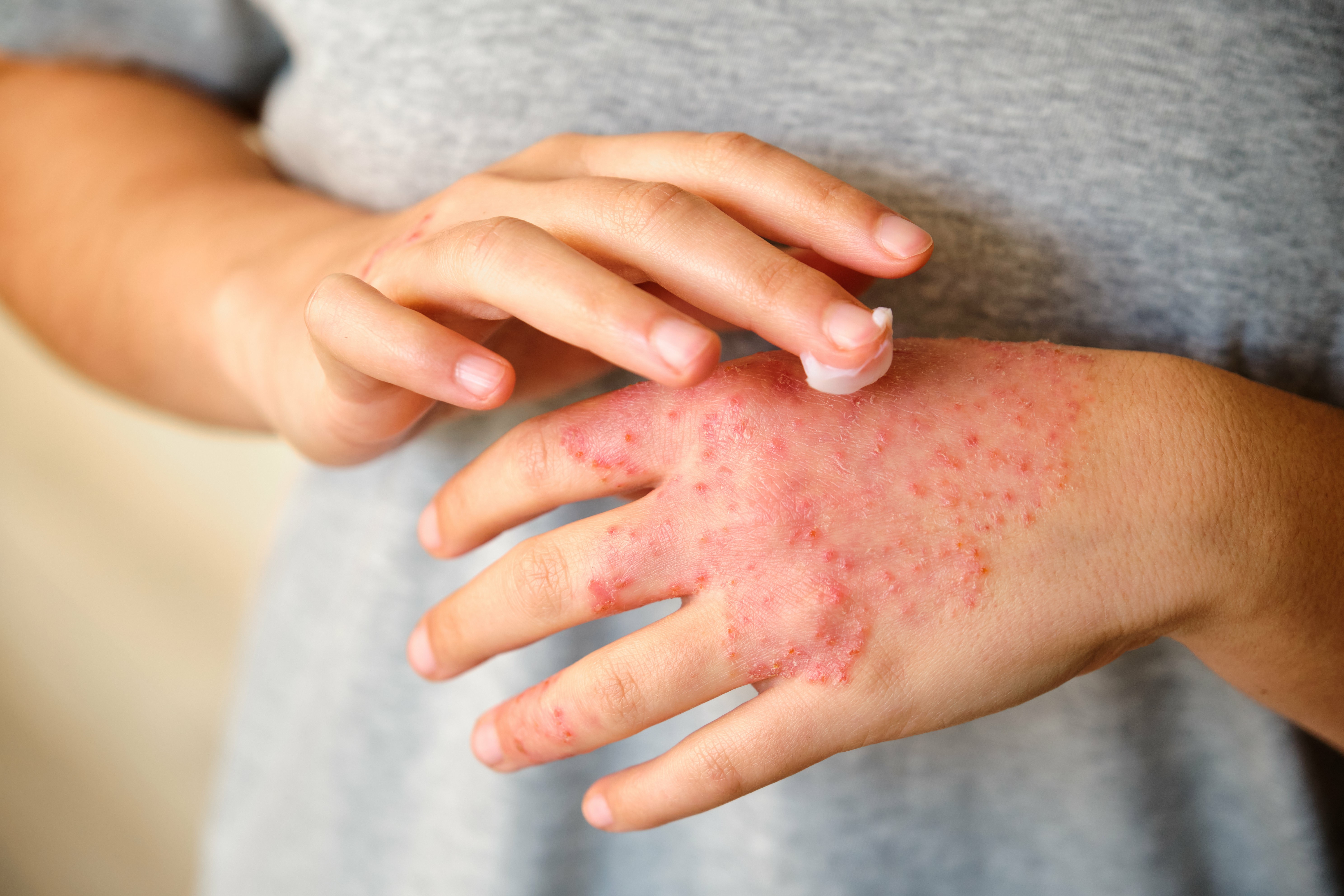 Quais são as causas da dermatite atópica e por que ela acontece?
