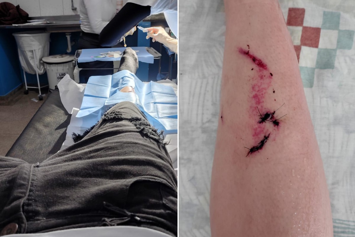 Jovem que caiu com arquibancada antes de show de Gian e Giovani diz que estrutura cedeu após estalo