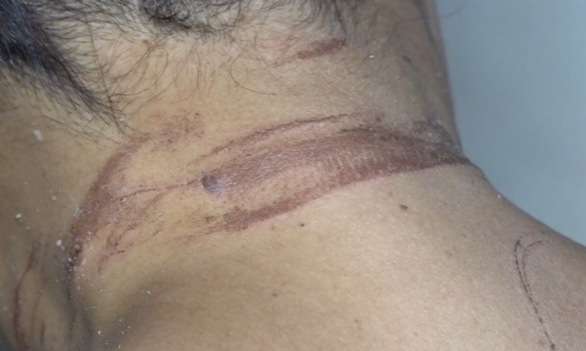 Mulher denuncia que foi enterrada viva pelo ex-namorado após tentativa de feminicídio na Bahia