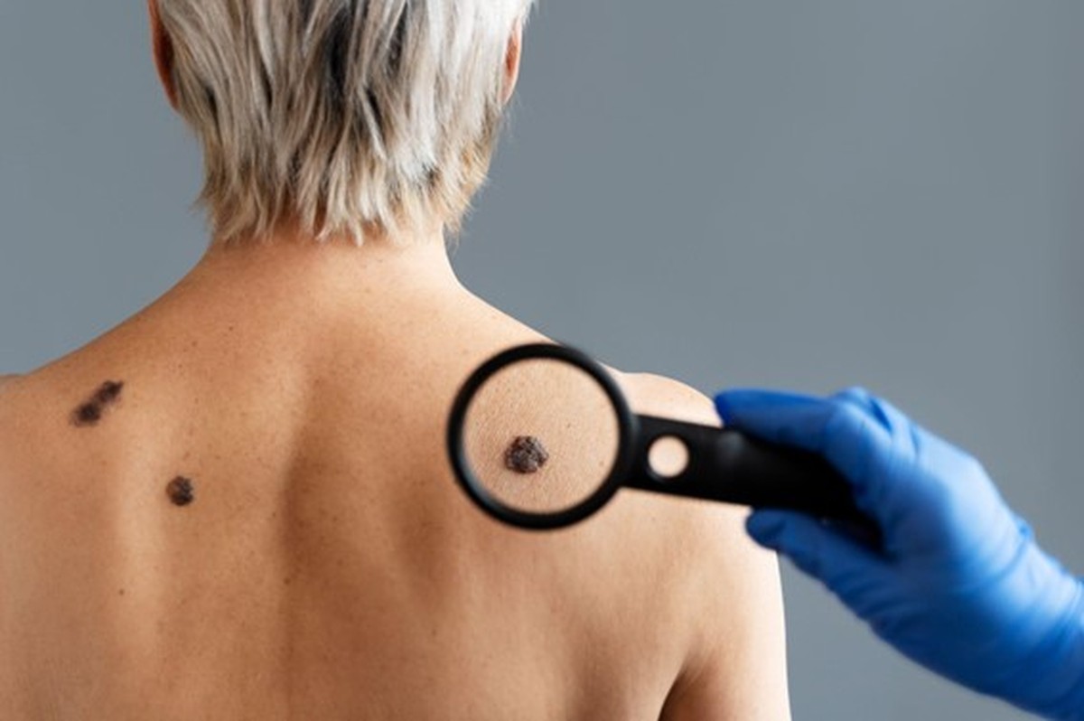 Hautkrebs: Arten, Diagnose und Prävention |  Krebs: von der Prävention bis zur Behandlung