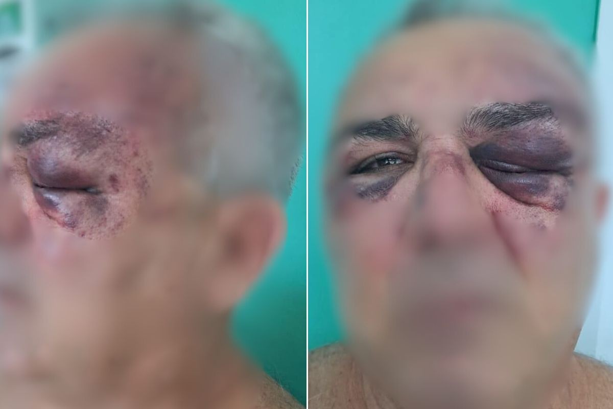 Aposentado é agredido por vizinho e fica com olhos roxos no litoral de SP 