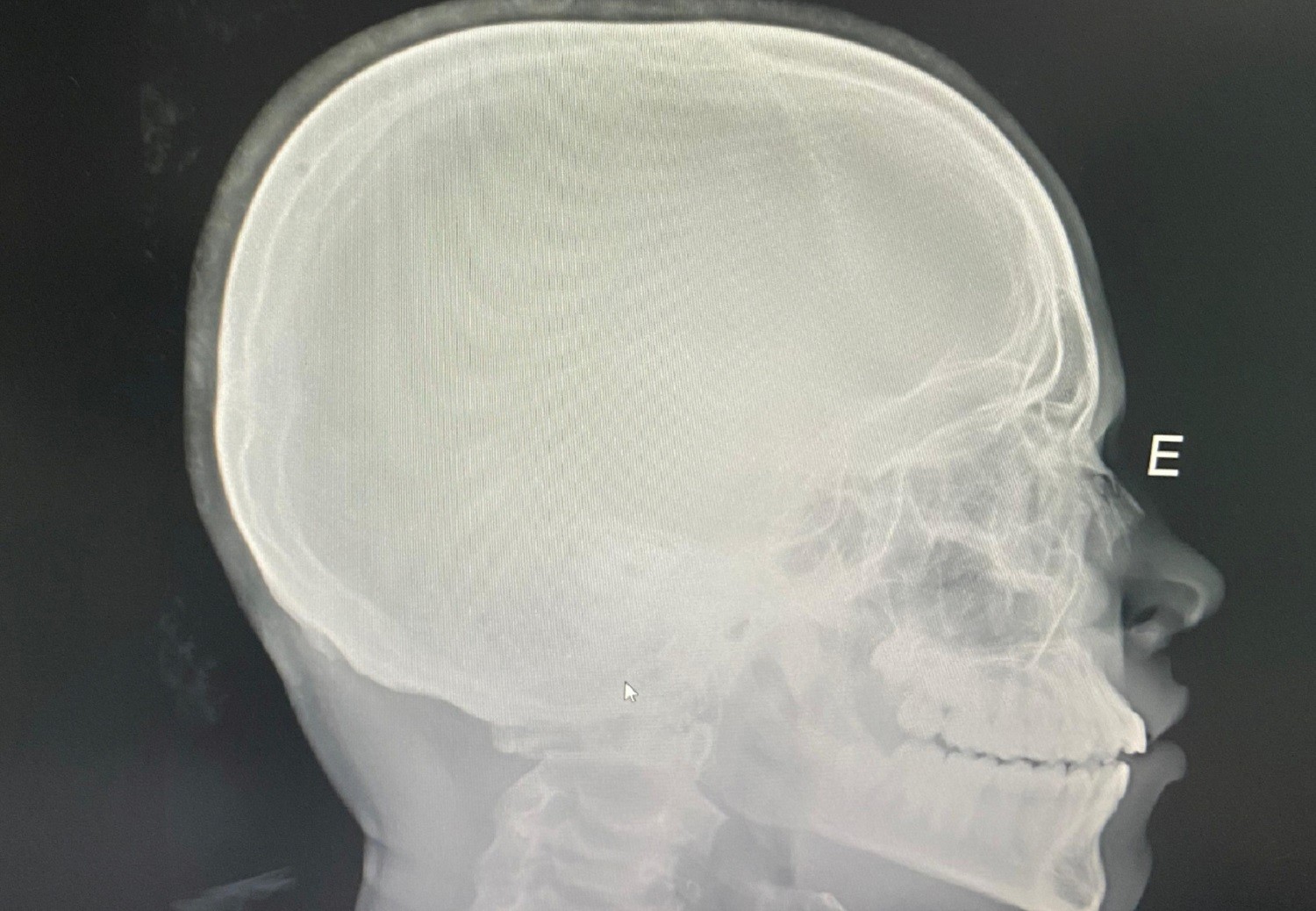 Estudante tem nariz quebrado após sofrer ofensas racistas e agressão em escola pública do Tocantins