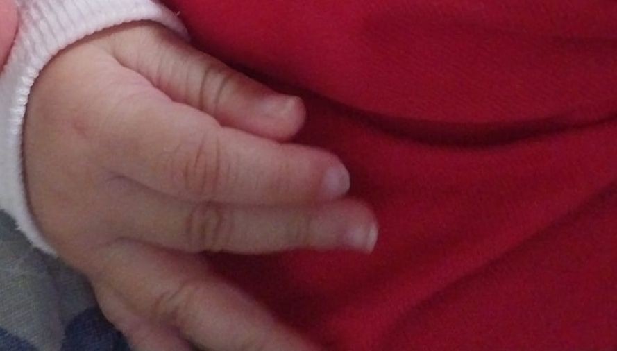 Bebê de três meses que teve objeto esquecido dentro de pulmão durante  intubação recebe alta em Sergipe