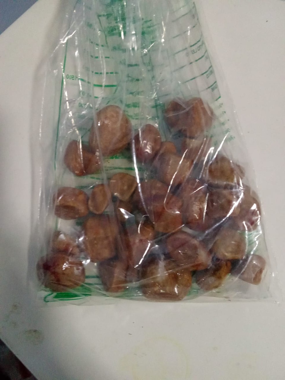 Pedras encontrada na bexiga de paciente no RN — Foto: Divulgação